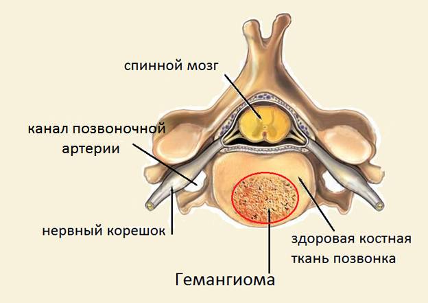 Если гемангиома будет таких размеров, что будет давить на спинной мозг, кровеносный сосуд или нервный корешок, то будут проявляться болевой и другие неврологические синдромы