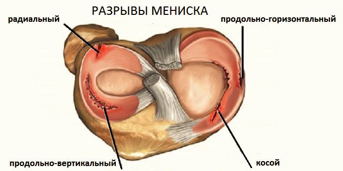 85% травматических повреждений колена – это разрывы хрящевых амортизаторов 85% травматических повреждений колена – это разрывы хрящевых амортизаторов