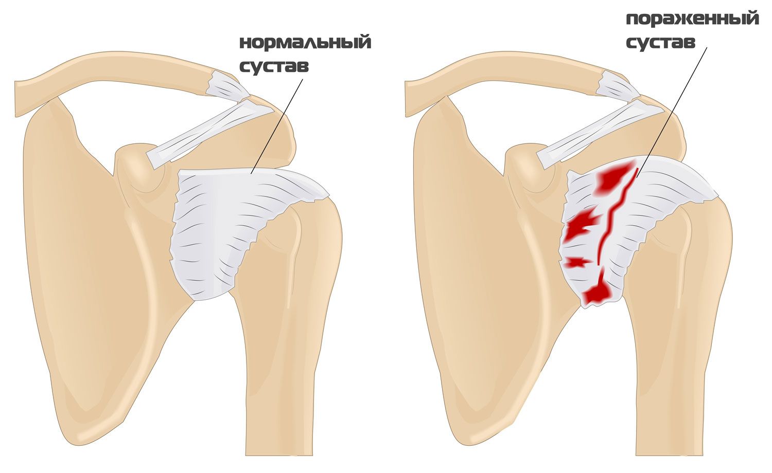 Артроз плечевого сустава образуется из-за нарушения структуры хряща Артроз плечевого сустава образуется из-за нарушения структуры хряща