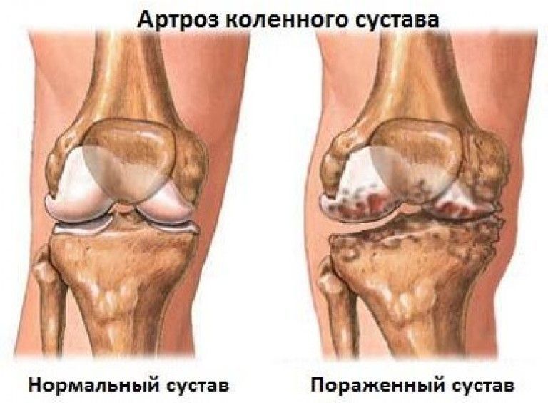 Артроз посттравматический коленного сустава прогрессирует из-за того, что в результате травмы была нарушена целостность тканей колена, вследствие чего нарушилась их трофика. Артроз посттравматический коленного сустава
