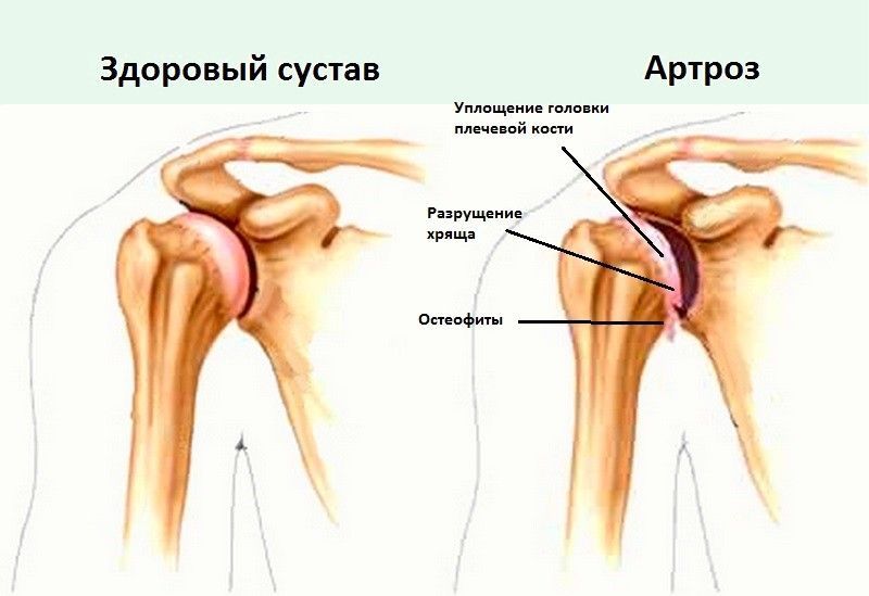 Больные и здоровые суставы Больные и здоровые суставы