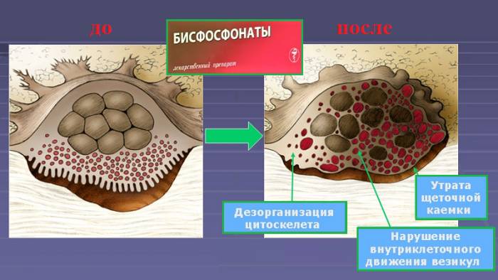 Деструкция функций остеокласта под воздействием бисфосфонат-содержащей кислоты Деструкция функций остеокласта под воздействием бисфосфонат-содержащей кислоты
