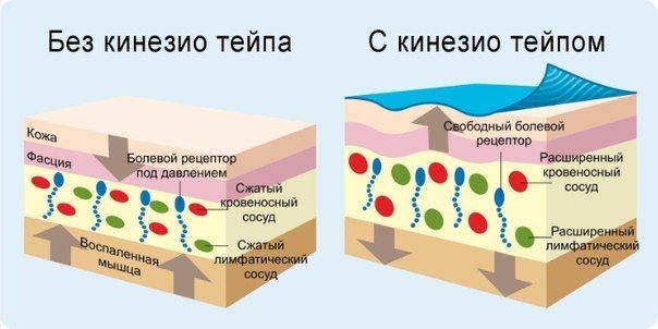 Эффект декомпрессии при наложении тейпа Эффект декомпрессии при наложении тейпа