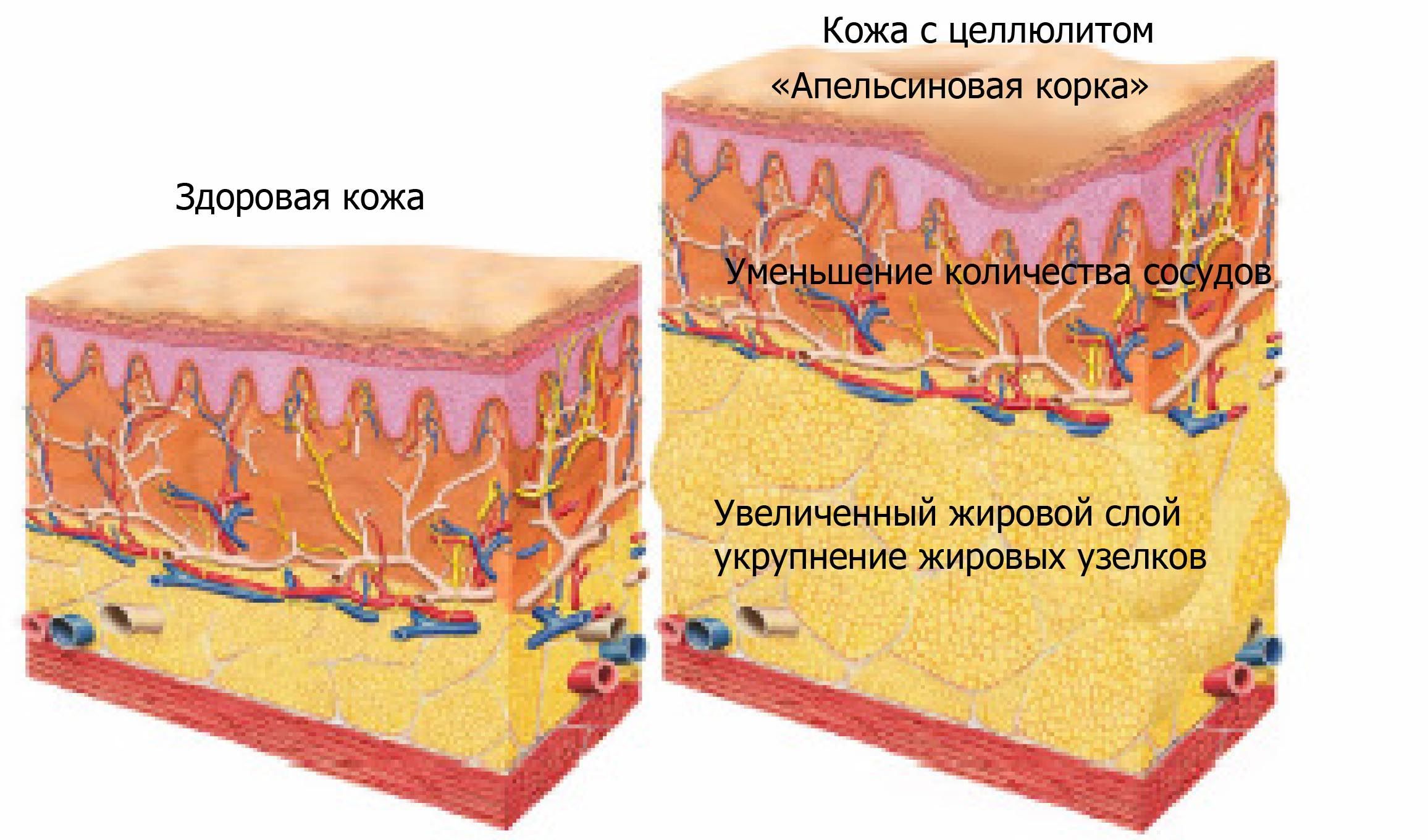 Гель Бишофит можно применять при целлюлите. Гель-мазь Бишофит можно применять при целлюлите.