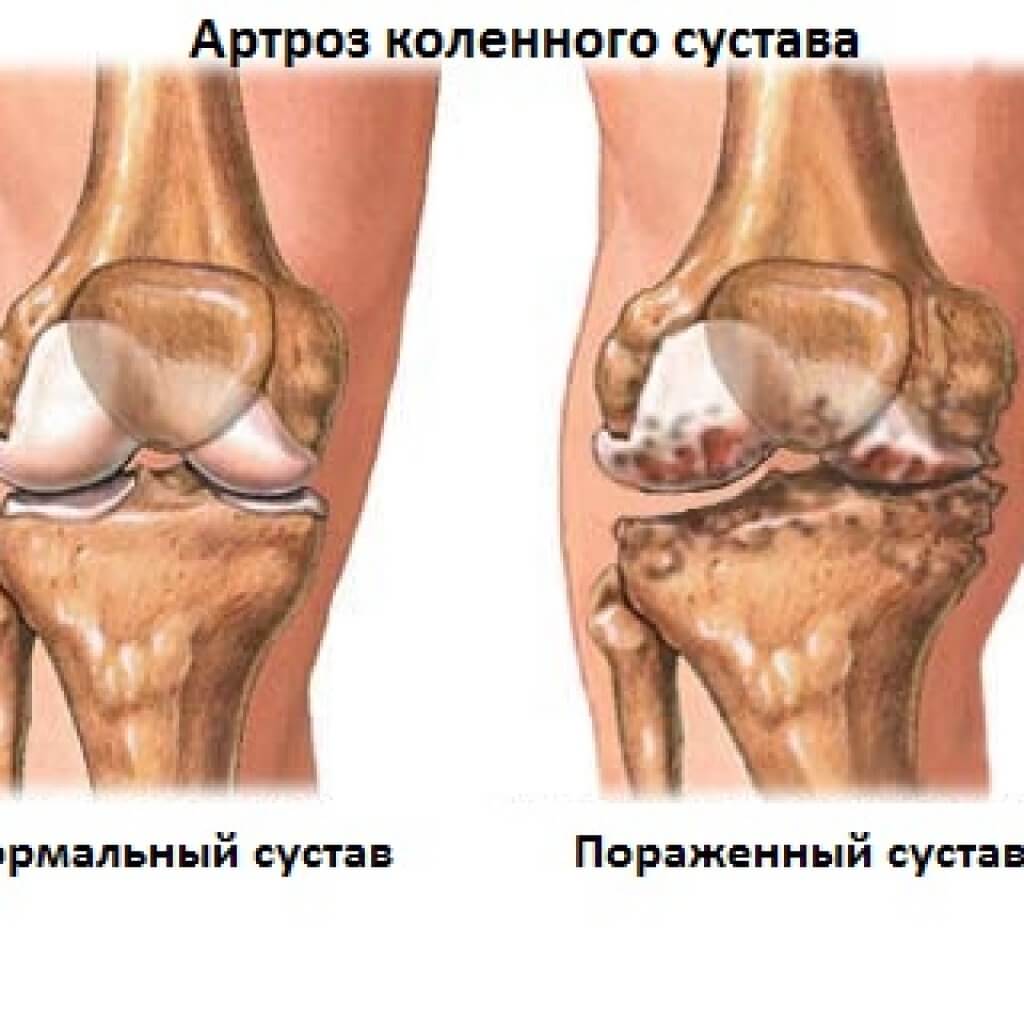 Хруст в коленном суставе — один из симптомов артроза Хруст в колене — один из симптомов артроза