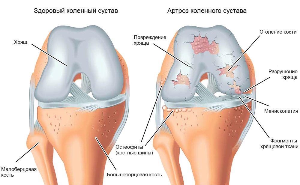 Изменения при артрозе Изменения при артрозе