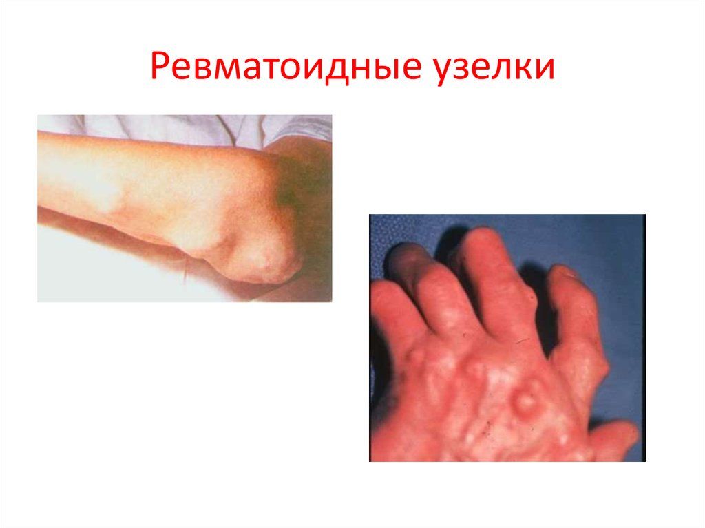 Как выглядят узелки суставов при ревматизме Как выглядят узелки суставов при ревматизме
