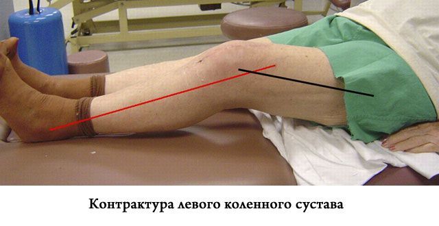 Контрактура колена значительно мешает больному при ходьбе. Контрактура колена значительно мешает больному при ходьбе.