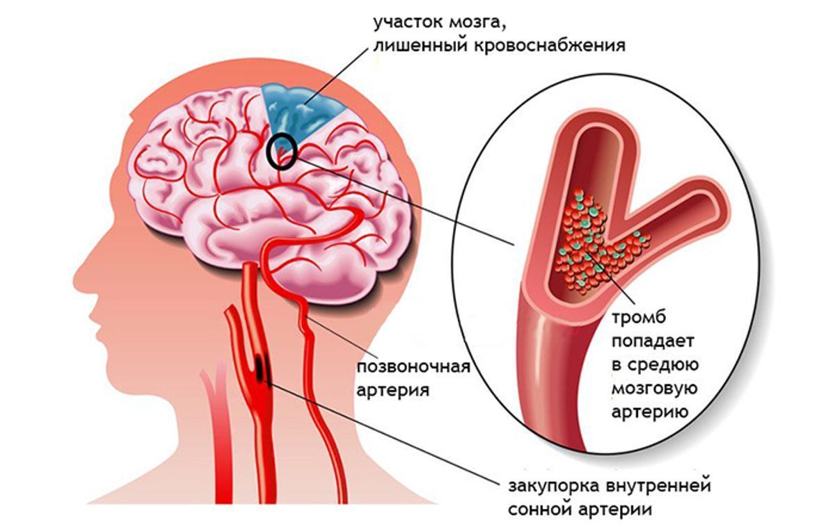 Критическое сужение сосуда может привести к развитию инсульта Критическое сужение сосуда может привести к развитию инсульта