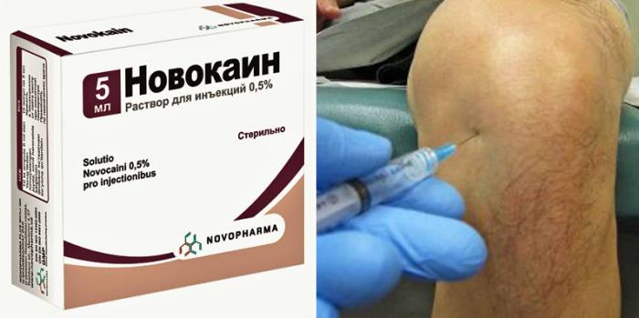 Купирование боли – результат «блокировки» натриевые каналов, передающих импульсы в головной мозг Купирование боли – результат «блокировки» натриевые каналов, передающих импульсы в головной мозг