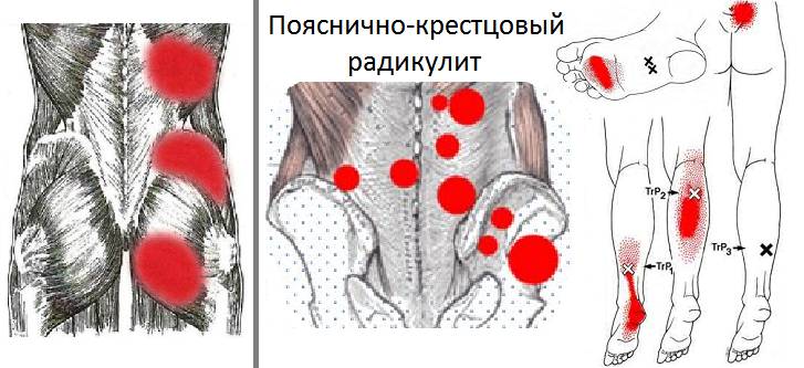 Мышечные «тиски» и триггерные точки при воспалении корешков поясницы Мышечные «тиски» и триггерные точки при воспалении корешков поясницы