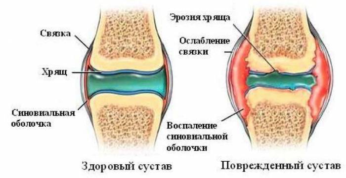 На фото изображены здоровый и поврежденный суставы На фото изображены здоровый и поврежденный суставы