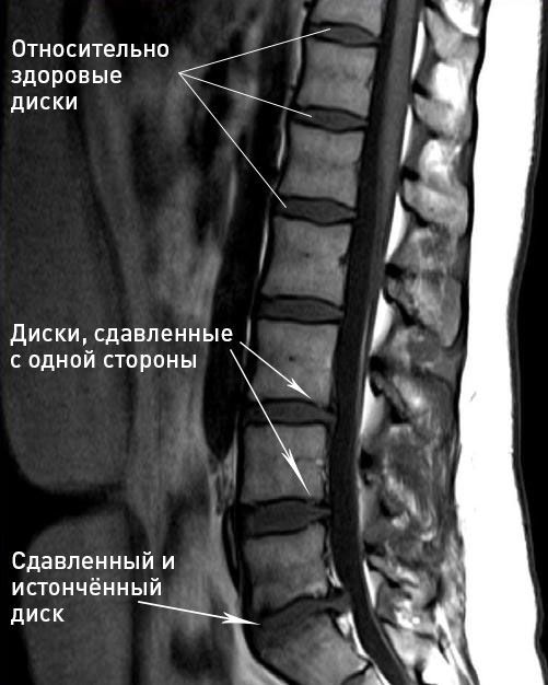 На фото наглядно показано истончение межпозвоночного диска На фото наглядно показано истончение межпозвоночного диска