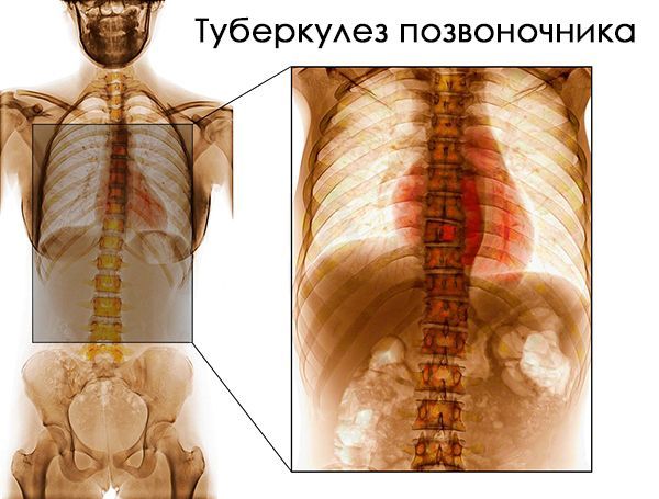 На фото – TBS позвоночника На фото – TBS позвоночника