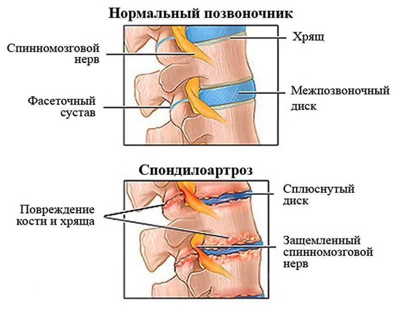 Наглядное представление патогенеза спондилоартроза Наглядное представление патогенеза спондилоартроза