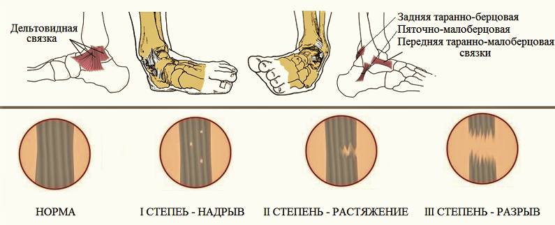 Названия наружных и внутренних связок голеностопа, возможные степени их повреждения Названия наружных и внутренних связок голеностопа, возможные степени их повреждения