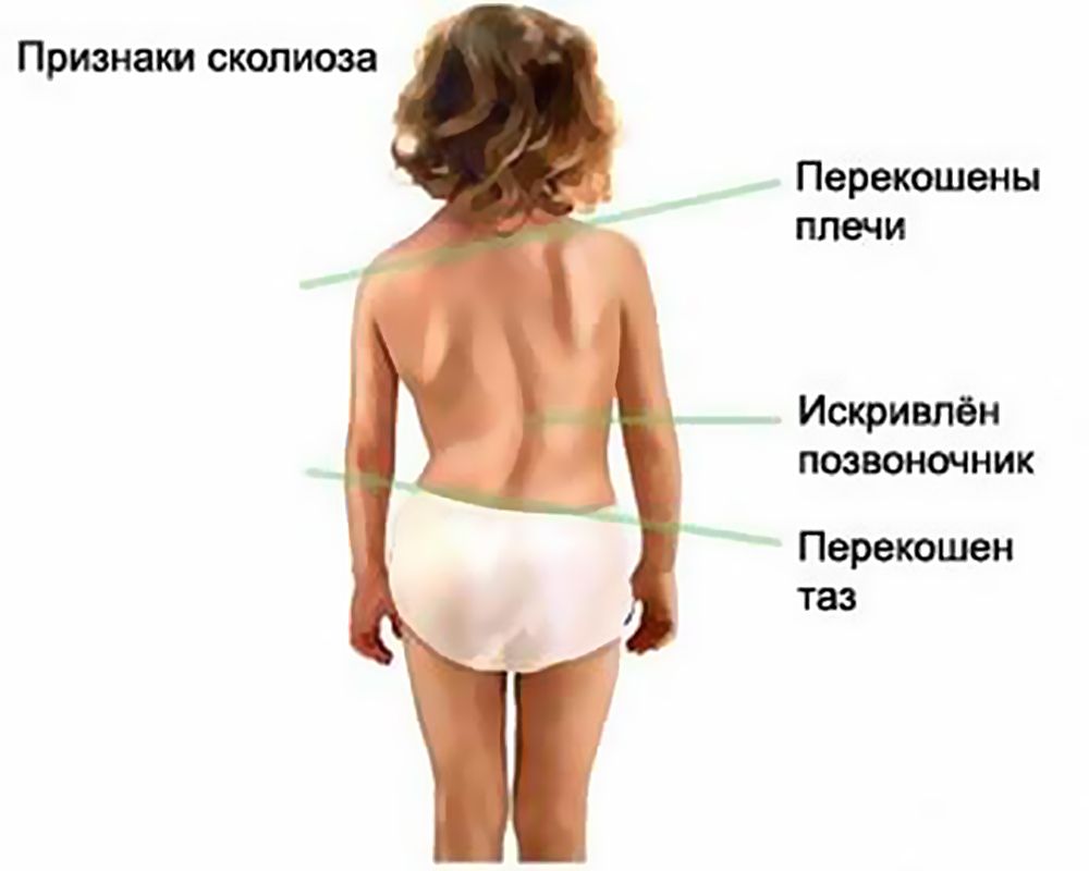 Некоторые признаки сколиоза можно увидеть при простом осмотре Некоторые признаки сколиоза можно увидеть при простом осмотре