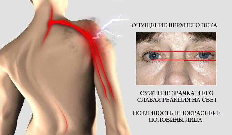 Один из признаков шейно-грудной радикулопатии (C8) – синдром Бернара-Горнера Один из признаков шейно-грудной радикулопатии (C8) – синдром Бернара-Горнера