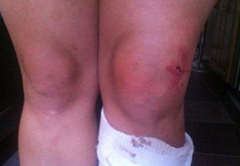 Одной из самых распространенных причин синовии являются травмы колена Одной из самых распространенных причин синовии являются травмы колена