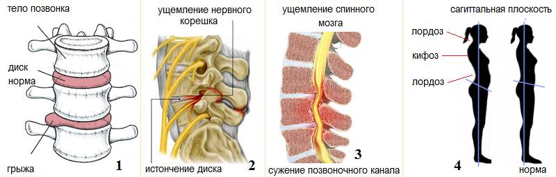 Осложнения остеохондроза – грыжа диска (1), радикулит (2), стеноз (3), искривление (4) Осложнения остеохондроза – грыжа диска (1), радикулит (2), стеноз (3), искривление (4)