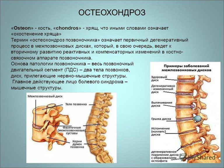 Остеохондроз при остеопорозе отягощается быстрым прогрессированием разрушения костных тканей в позвоночнике. Остеохондроз при остеопорозе отягощается быстрым прогрессированием разрушения костных тканей в позвоночнике.
