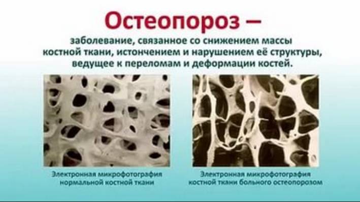 Остеопороз бывает первичный и вторичный. Остеопороз бывает первичный и вторичный.