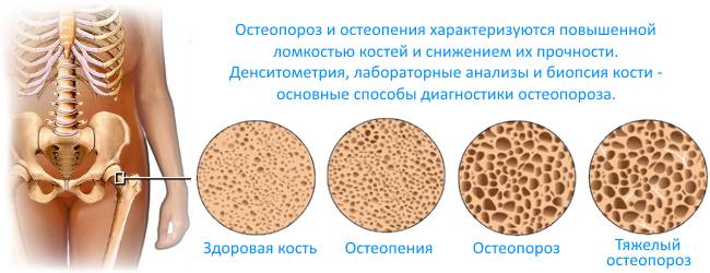 Остеопороз имеет свою классификацию по тяжести недуга. Остеопороз имеет свою классификацию по тяжести недуга.