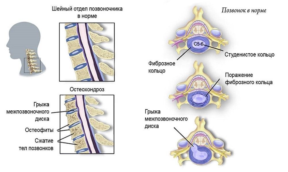 Патогенез остеохондроза Патогенез остеохондроза
