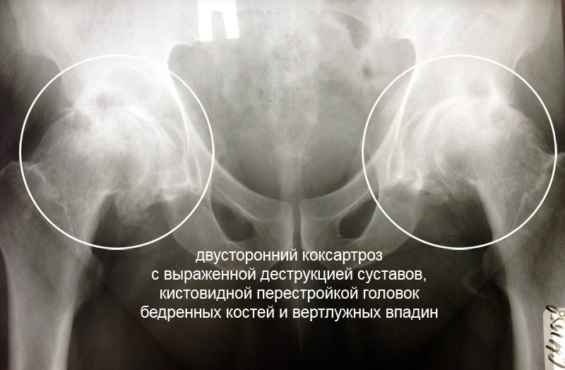 Перед тем, как будут назначены физические упражнения при коксартрозе тазобедренного сустава и другая терапия, больному должен быть точно поставлен диагноз. Перед тем, как будут назначены физические упражнения при коксартрозе тазобедренного сустава и другая терапия, больному должен быть точно поставлен диагноз.