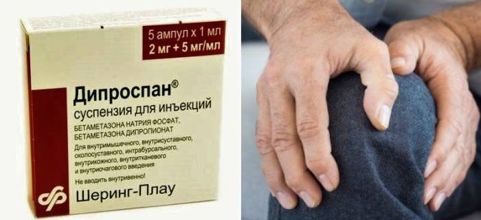 Периодичность инъекций Дипроспана (бетаметазона) – 1 раз в 1,5-2 месяца Периодичность инъекций Дипроспана (бетаметазона) – 1 раз в 1,5-2 месяца