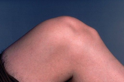 Подколенная шишка может остаться на всю жизнь и потребовать пластической коррекции Подколенная шишка может остаться на всю жизнь и потребовать пластической коррекции