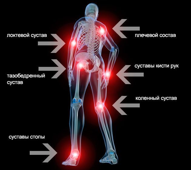 Полиартрит обычно возникает вследствие системного заболевания и поражает несколько сочленений Полиартрит обычно возникает вследствие системного заболевания и поражает несколько сочленений