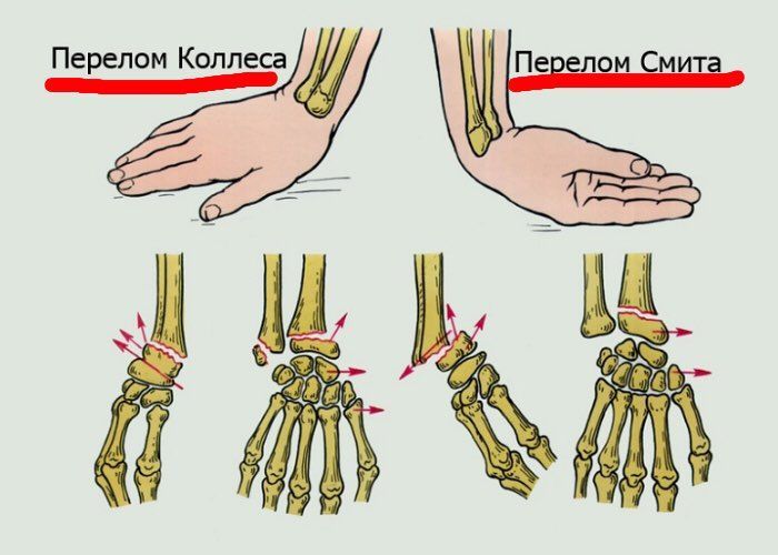 Получение травмы при падении на кисть. Получение травмы при падении на кисть.