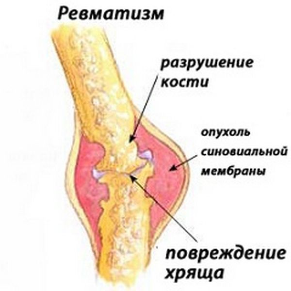 Поражение хряща ревматизмом Поражение хряща ревматизмом