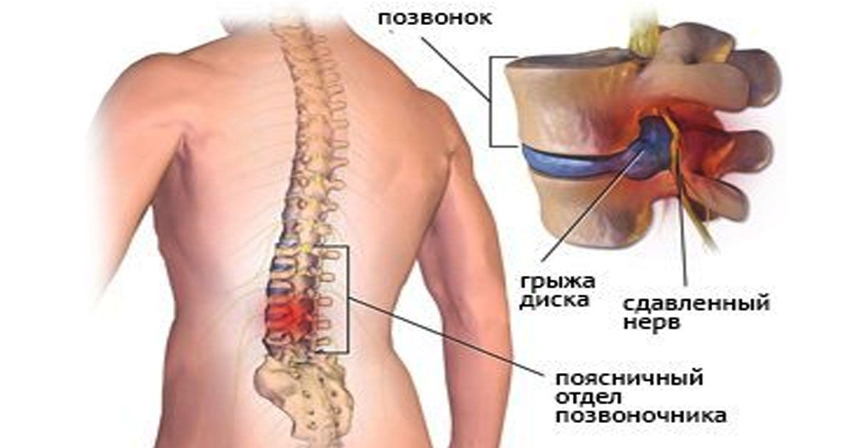 При сильном дискомфорте в области спины и нарушении чувствительности разрабатывается максимально эффективная схема терапии традиционными методами. При сильном дискомфорте в области спины и нарушении чувствительности разрабатывается максимально эффективная схема терапии традиционными методами.