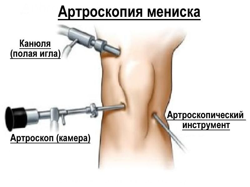 Проведение артроскопической процедуры при лечении мениска колена. Проведение артроскопической процедуры при лечении мениска колена.