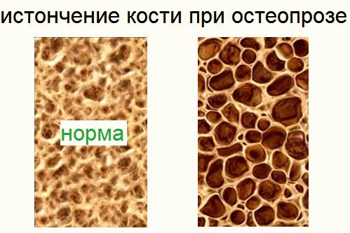 С возрастом к остеохондрозу «присоединяется» другой недуг – остеопороз С возрастом к остеохондрозу «присоединяется» другой недуг – остеопороз