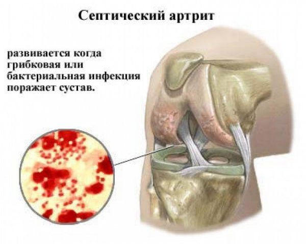 Септический артрит провоцирует инфекция в организме Септический артрит провоцирует инфекция в организме