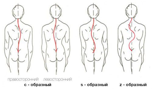 Сколиозы бывают трёх видов: С-образные, S-образные и Z-образные. Последние встречаются крайне редко. Все разновидности могут быть левосторонними или правосторонними. Сколиозы бывают трёх видов: С-образные, S-образные и Z-образные. Последние встречаются крайне редко. Все разновидности могут быть левосторонними или правосторонними.