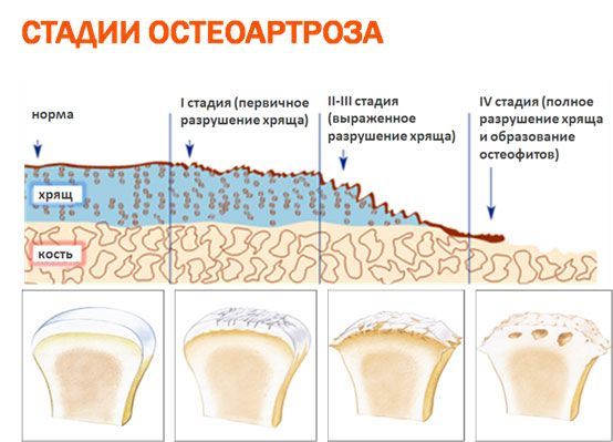 Состояние больного остеопорозом ухудшается от стадии к стадии. Состояние больного остеопорозом ухудшается от стадии к стадии.