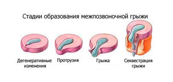 Стадии формирования грыжи между позвонками Стадии формирования грыжи между позвонками