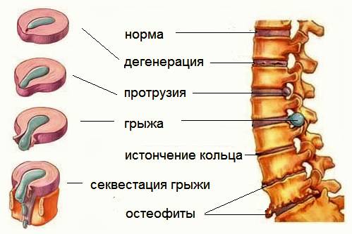Стадии развития остеохондроза Стадии развития остеохондроза
