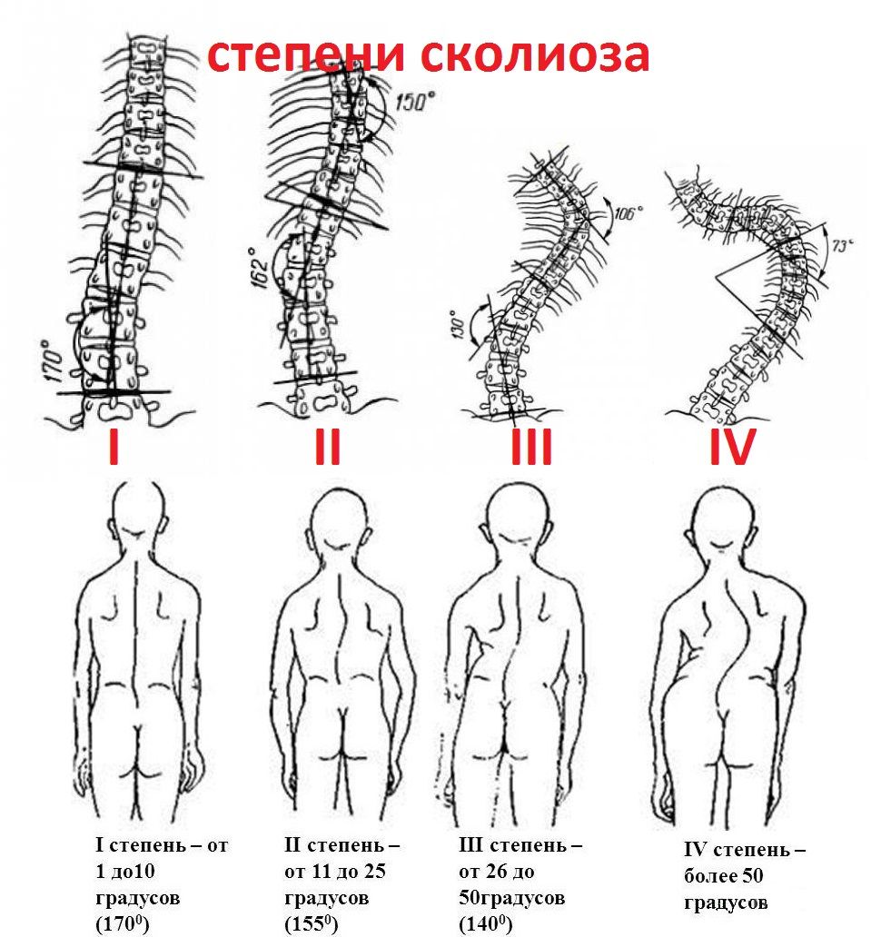 Степень патологии определяется в зависимости от градуса искривления Степень патологии определяется в зависимости от градуса искривления