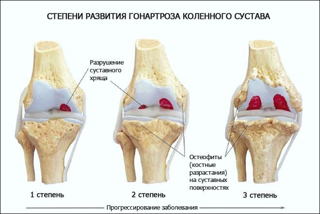 Существует 3 основные стадии развития посттравматического артроза колена. Существует 3 основные стадии развития посттравматического артроза колена.