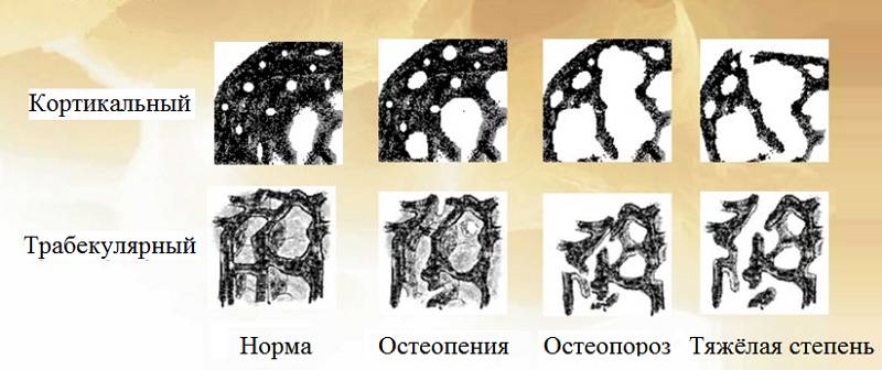 Типы структурных изменений и степень тяжести остеопорозного процесса Типы структурных изменений и степень тяжести остеопорозного процесса