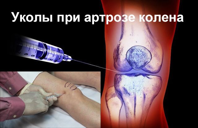 Уколы в сустав при артрозе выполняются только квалифицированным медперсоналом в больнице! Уколы в сустав при артрозе выполняются только квалифицированным медперсоналом в больнице!