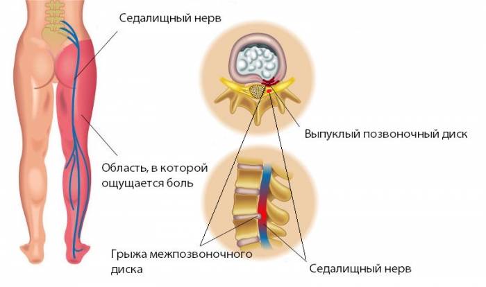Ущемление корешка в пояснице и ишиас – результат давления межпозвонковой грыжи Ущемление корешка в пояснице и ишиас – результат давления межпозвонковой грыжи