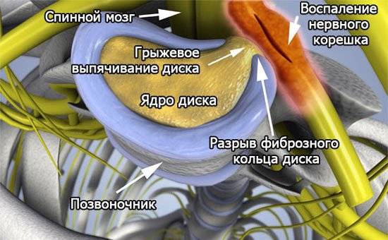 В 90 % случаев ущемление нервного корешка – это давление грыжи межпозвонкового диска В 90 % случаев ущемление нервного корешка – это давление грыжи межпозвонкового диска