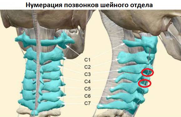 В красных овалах – поражённые диски-«виновники» ощущения кома в горле В красных овалах – поражённые диски-«виновники» ощущения кома в горле
