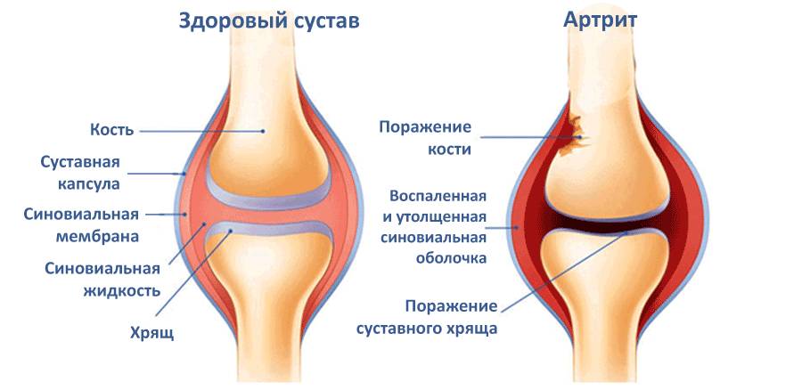 Воспалительный процесс при артрите чаще всего возникает в результате инфекционного процесса в организме либо как осложнение после травм. Какая патология суставов таза, колена или стопы хуже?